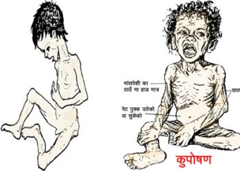 बालबालिकामा कुपोषण