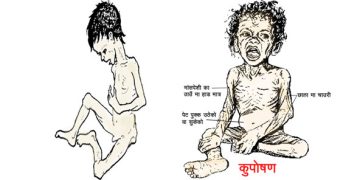 बालबालिकामा कुपोषण